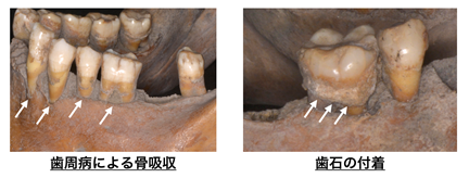 図1.江戸時代の人骨と付着した歯石